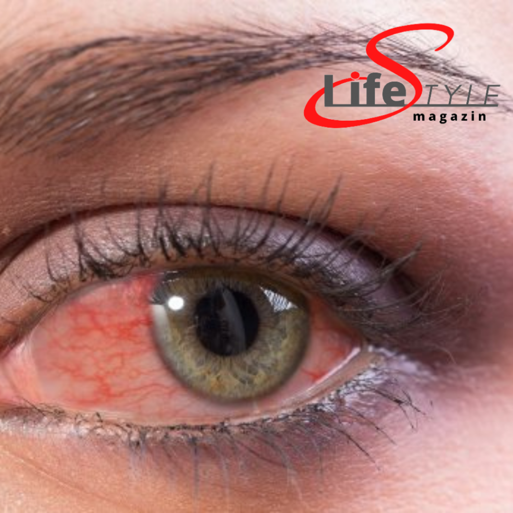 Vörös szem - LifestyleMagazin