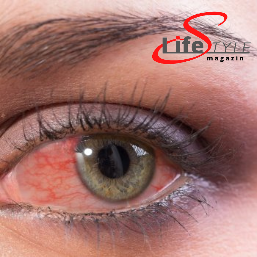 Vörös szem - LifestyleMagazin